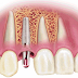 Cấy ghép Implant Hàn Quốc ở đâu tốt, an toàn, không đau?