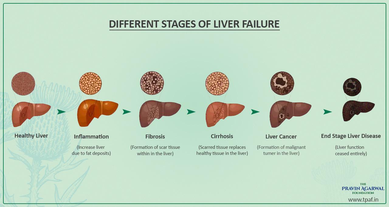 What Are The Different Stages Of Liver Failure?