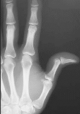 Dislocated finger joint
