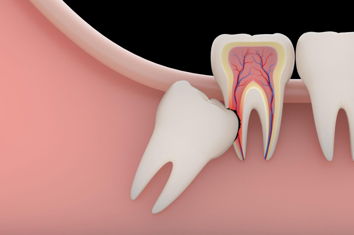 wisdom tooth extraction in Toronto