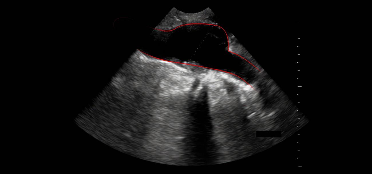 Ultrasound images of Aortic aneurysm - Radiology Imaging