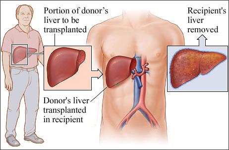 Best Liver Transplantation in India - Best Liver Transplant Hospital - Liver Transplant Surgery