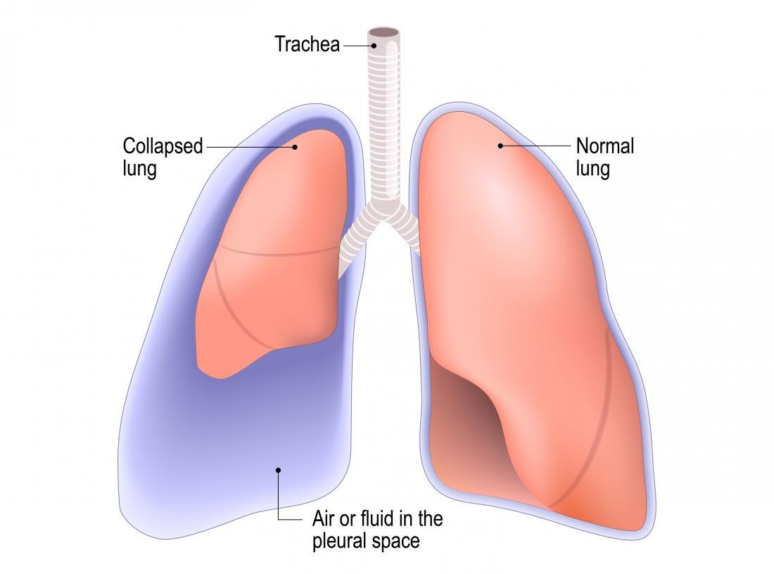 Punctured lung (pneumothorax): Symptoms, treatment, and recovery