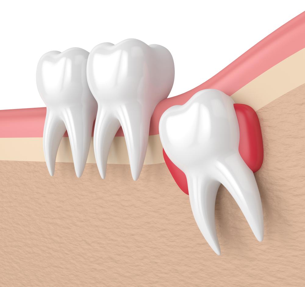 Richmond Hill tooth extraction services