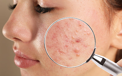 11 Habits That Make Acne Worse – SkinKraft , Makeup Products ,Skin issues, Negative Effects, Skin care, Habits , Aging, Overtime, OIL, Worse, Harmful.