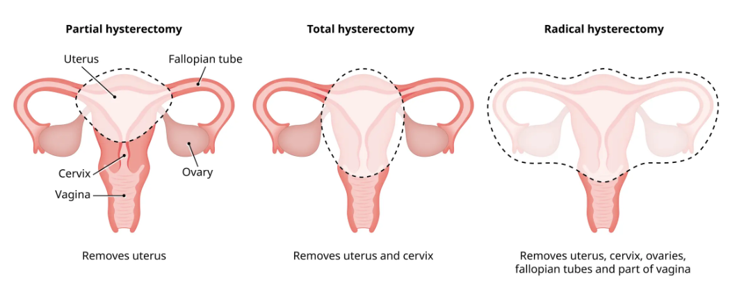Understanding Ovarian Cyst After Hysterectomy