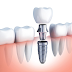 Chi phí trồng răng implant