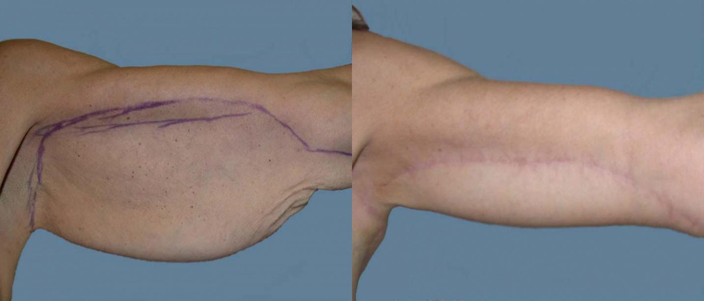 Arm Lift Recovery - What to Expect - Gaines Plastic Surgery