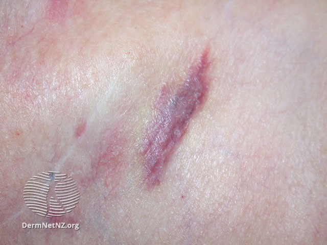 Cureus  Cutaneous Dermal Metastasis of Inflammatory Breast