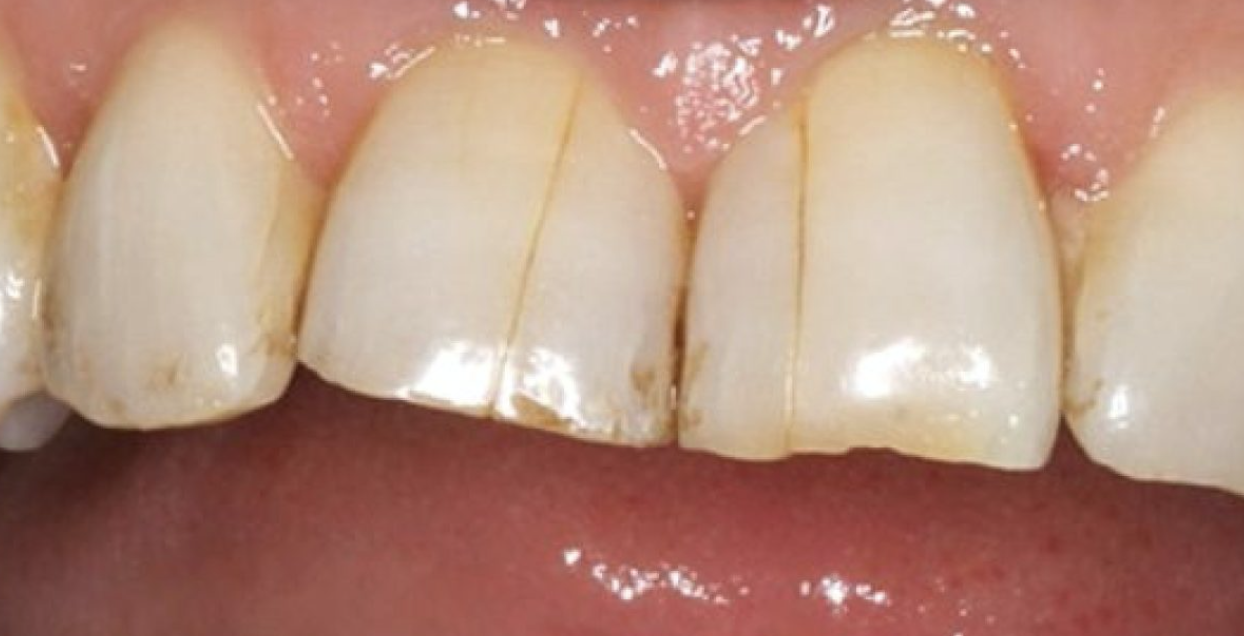 Cracks on front teeth