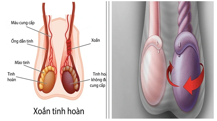 xoắn tinh hoàn