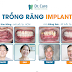 5 Dòng Trụ Implant Thụy Sĩ Chất Lượng Cao