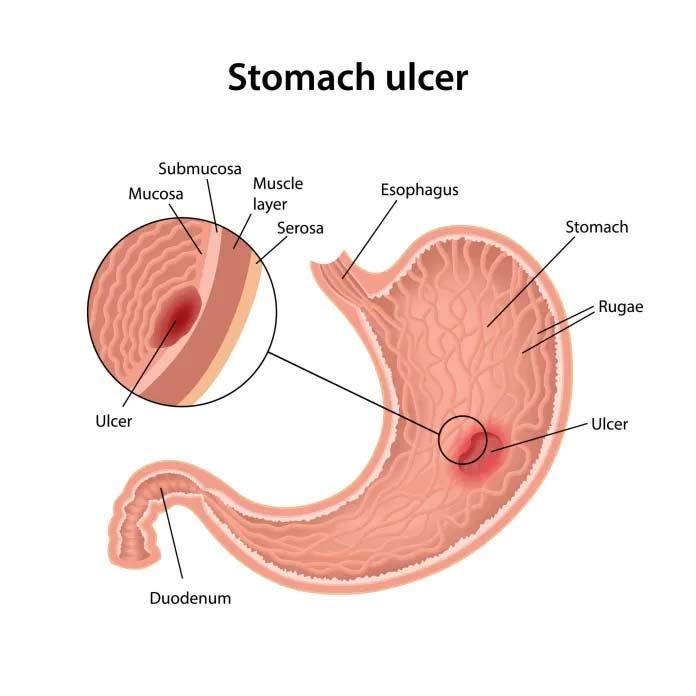 What are Stomach Ulcers? | Stomach Ulcer Symptoms, Causes, Treatmen