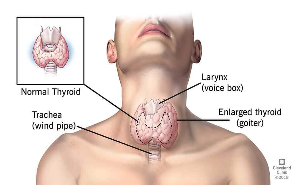 Hypothyroidism Los Angeles - Southern California Center For Anti-Aging