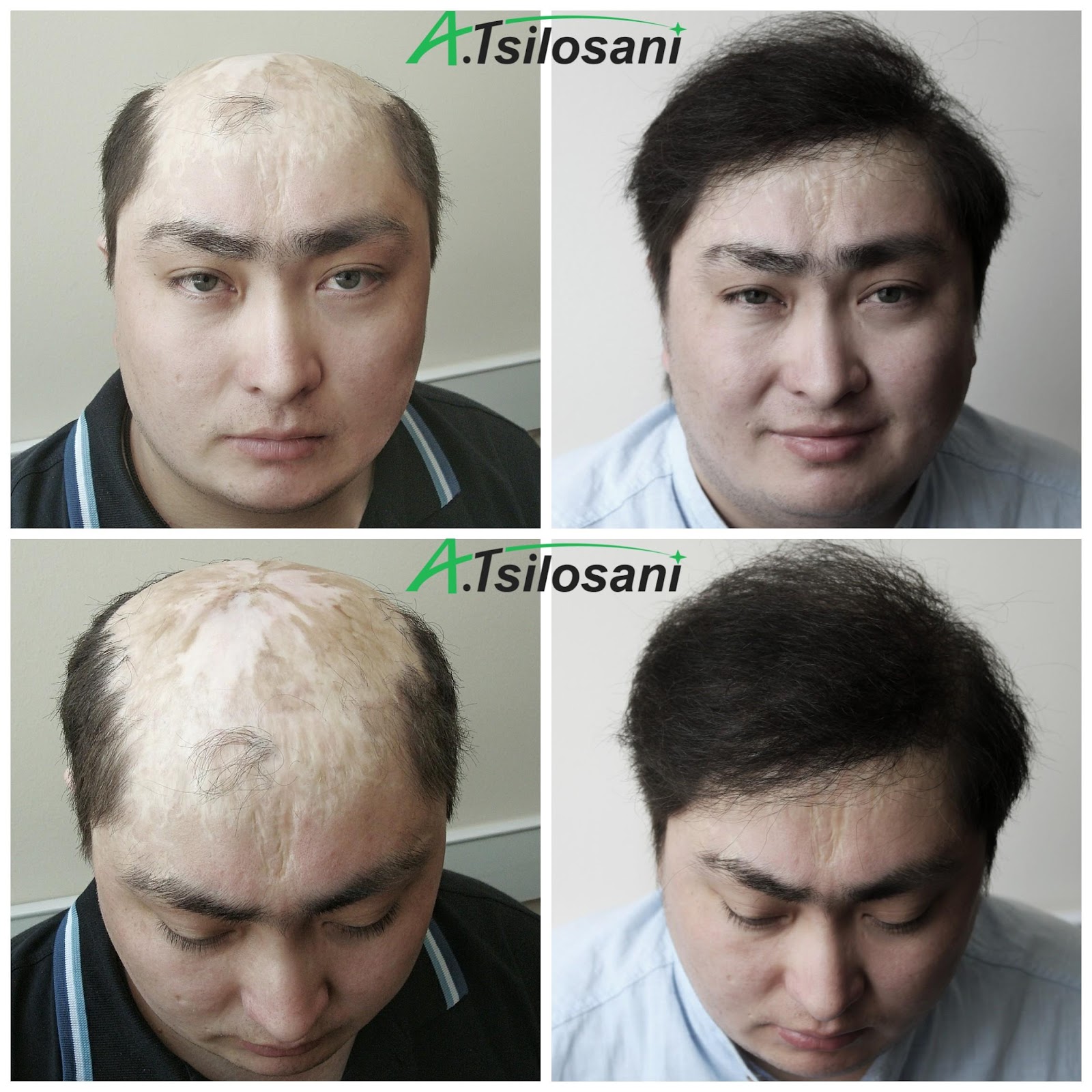 Foto%2012.%20Hair%20transplant%20before%20and%20after%205000%20grafts%20with%20FUT%20method%20
