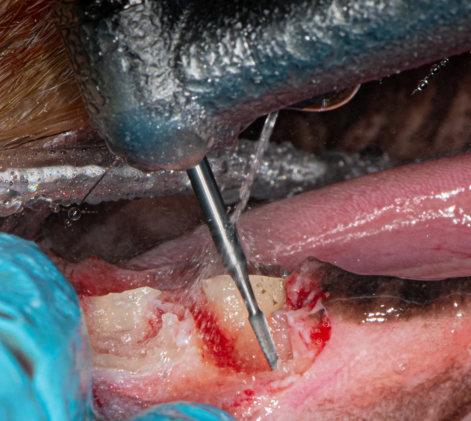 figure 4a: A #701S bur used to remove buccal alveolar bone overlying the mandibular first molar roots