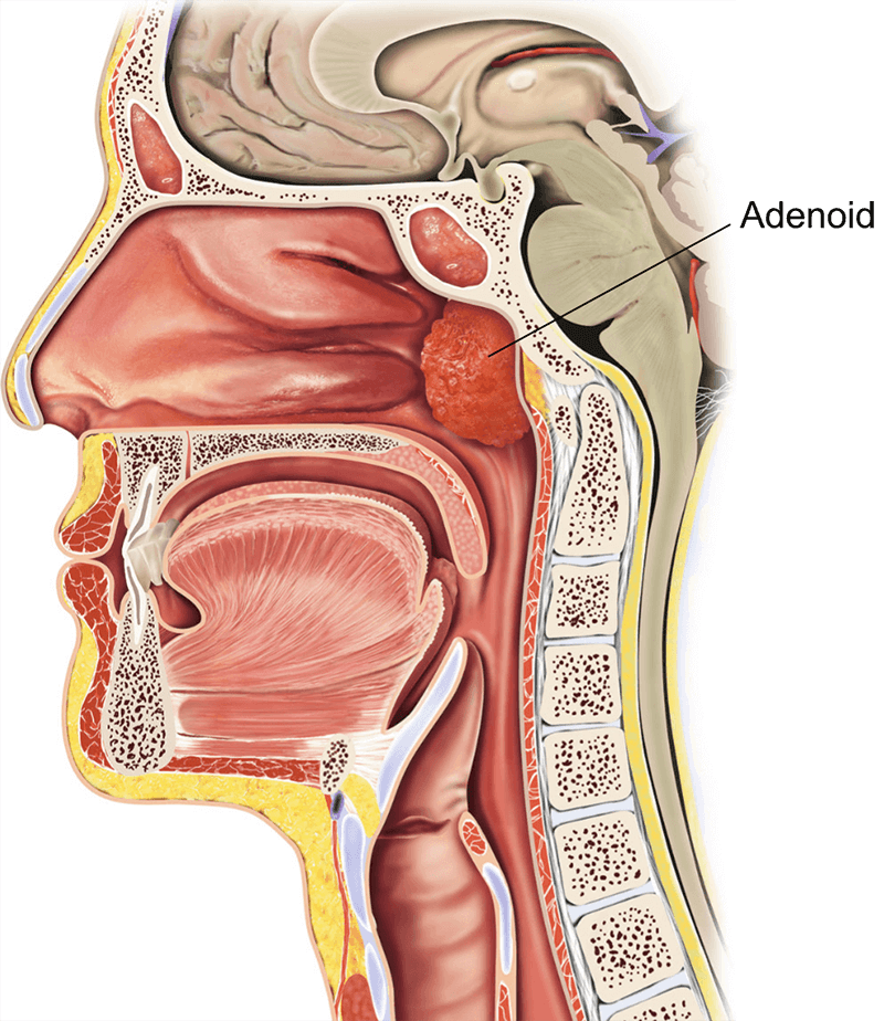 Adeno-tonsillectomy (child) | healthdirect