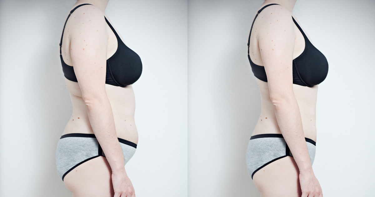 Body Feminization Surgery Before And After