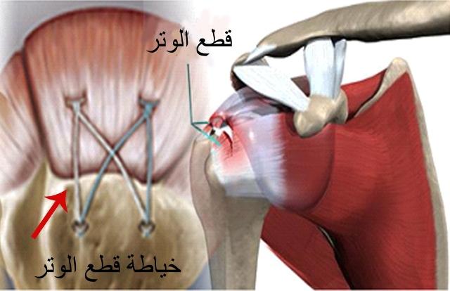 E:\Documents and Settings\USER\Desktop\كبار السن\قطع وتر.jpg