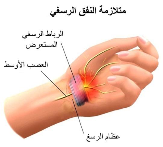 E:\Documents and Settings\USER\Desktop\كبار السن\متلازمة النفق الرسغي.jpg