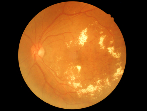 OCT screen of Diabetic retinopathy. 