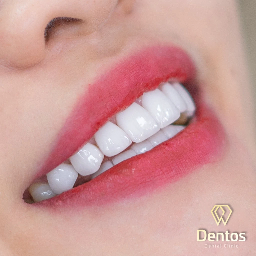 Trả lời thắc mắc: Làm răng sứ bao nhiêu tiền? Vì sao nên bọc răng sứ thẩm mỹ tại nha Khoa Dentos?