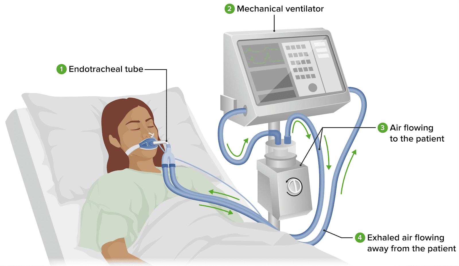 Invasive Mechanical Ventilation | Concise Medical Knowledge