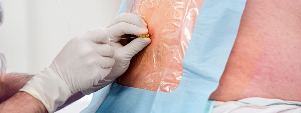 En epidural injiserer medisin i rommet rundt ryggmargens nerver, kjent som epiduralrommet. 