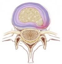 https://www.physio-pedia.com/images/thumb/a/a6/Disc_protrusion.jpg/200px-Disc_protrusion.jpg