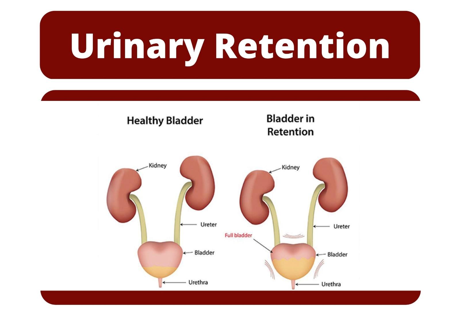 Urinary Retention | Urolife Clinic