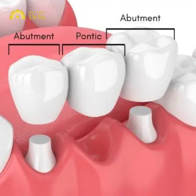 Cầu răng sứ là phương pháp phục hình răng được sử dụng để thay thế cho một hoặc nhiều răng đã mất.