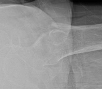 A close-up of a bone
Description automatically generated