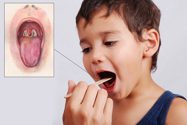 Bệnh bạch hầu thường xuất hiện ở trẻ nhỏ với những biến chứng vô cùng nguy hiểm