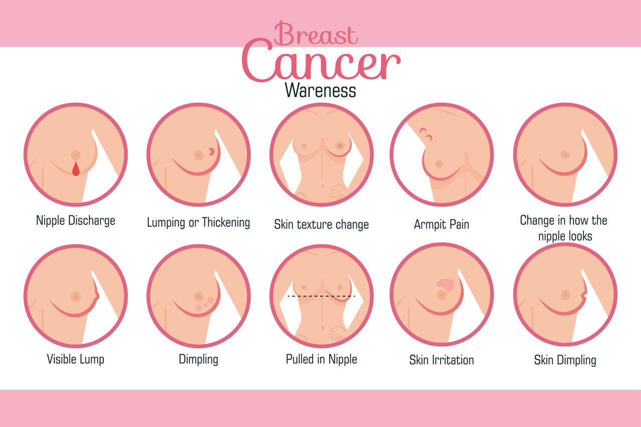 سرطان  الثدي الخبيث ومراحله 