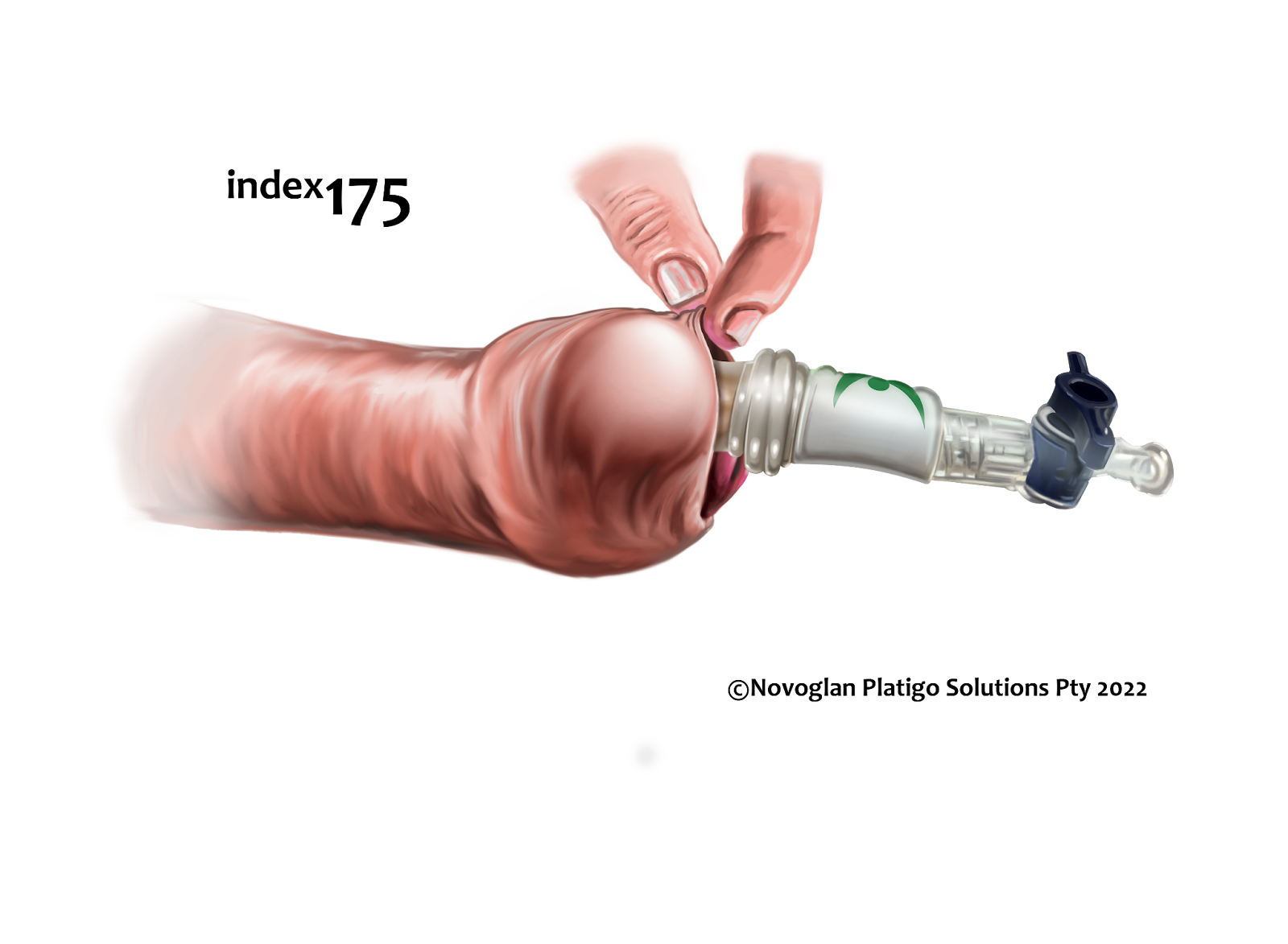 How Novoglan is inserted under the foreskin.