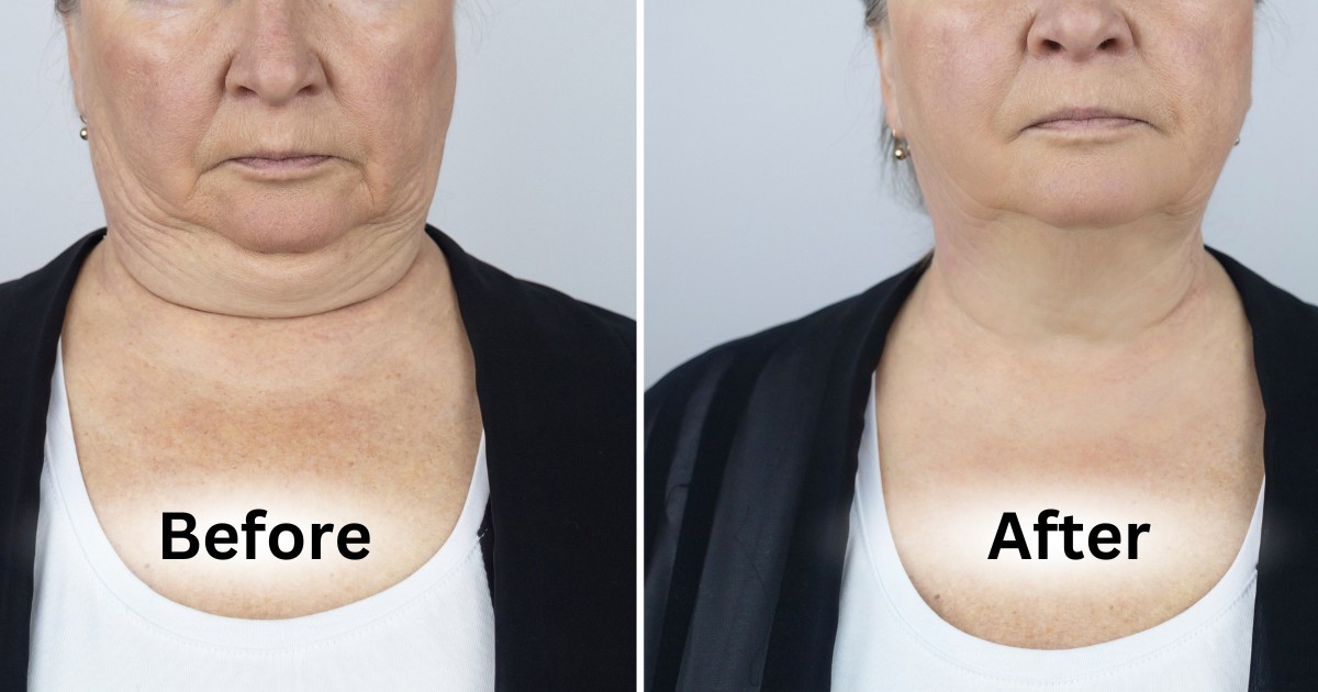 Liposuction Chin Before And After