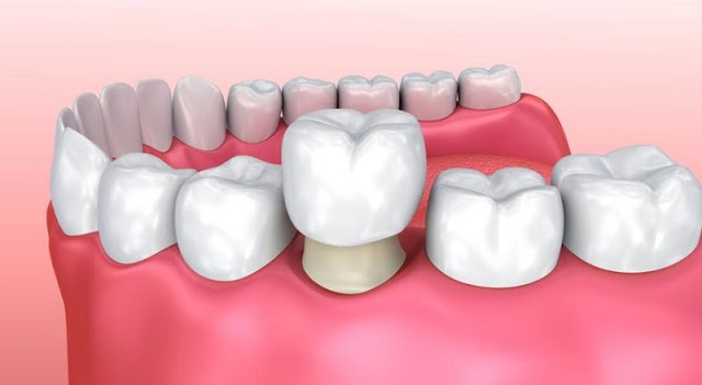 boc-rang-su-zirconia-co-tot-khong-3