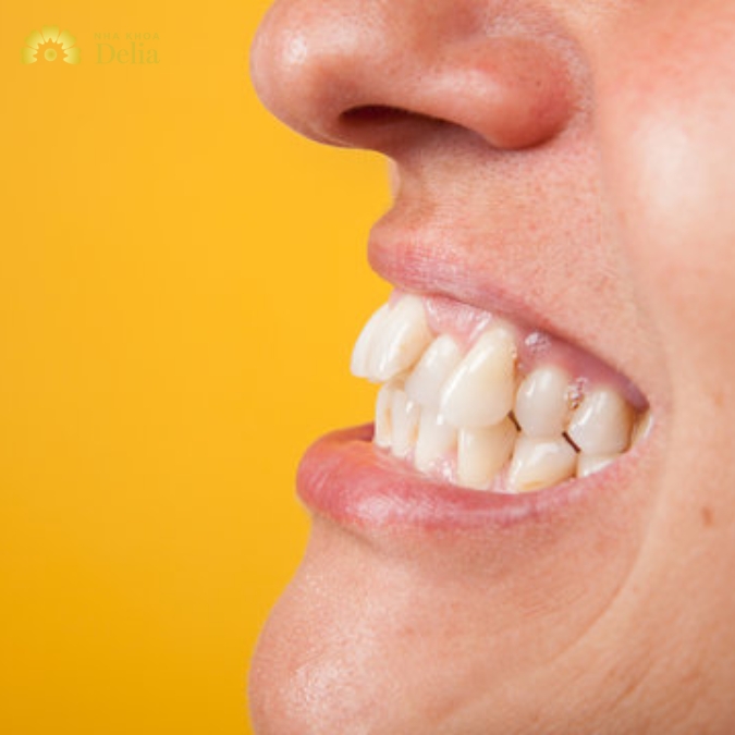 Răng hô là răng như thế nào?