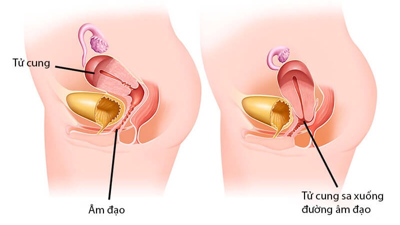 Siêu âm có phát hiện sa tử cung: Những điều bạn cần biết