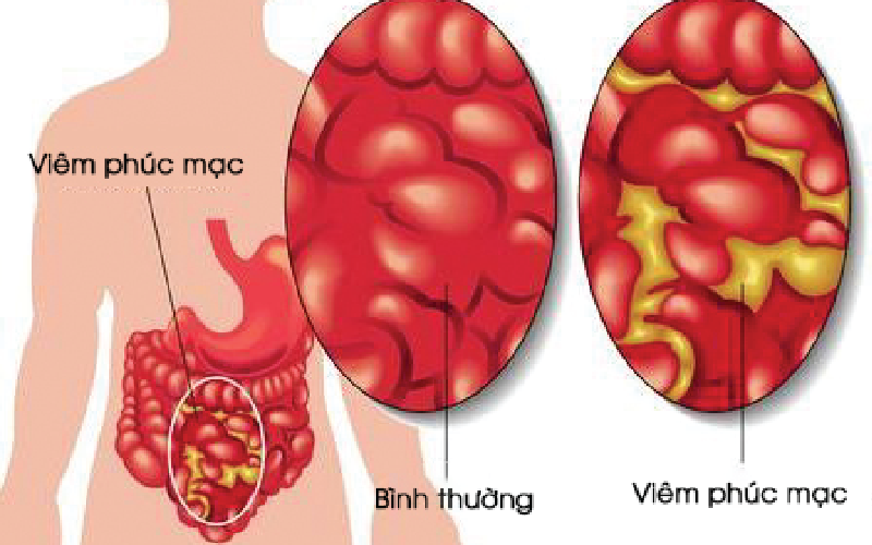 Viêm phúc mạc - Biến chứng sỏi túi mật hoặc biến chứng sau mổ sỏi mật