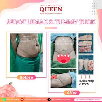 Operasi Sedot Lemak, Manfaat, Harga, Dan Hal Yang Harus Diketahui - KLINIK  BEDAH PLASTIK QUEEN - SOLO