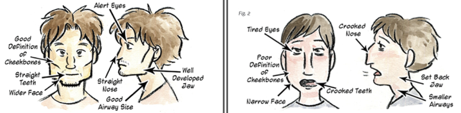 Comparison of poor craniofacial formation and proper craniofacial formation