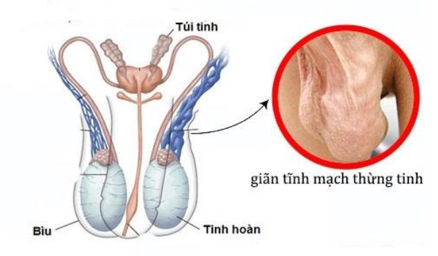 Giãn tinh mạch thừng tinh