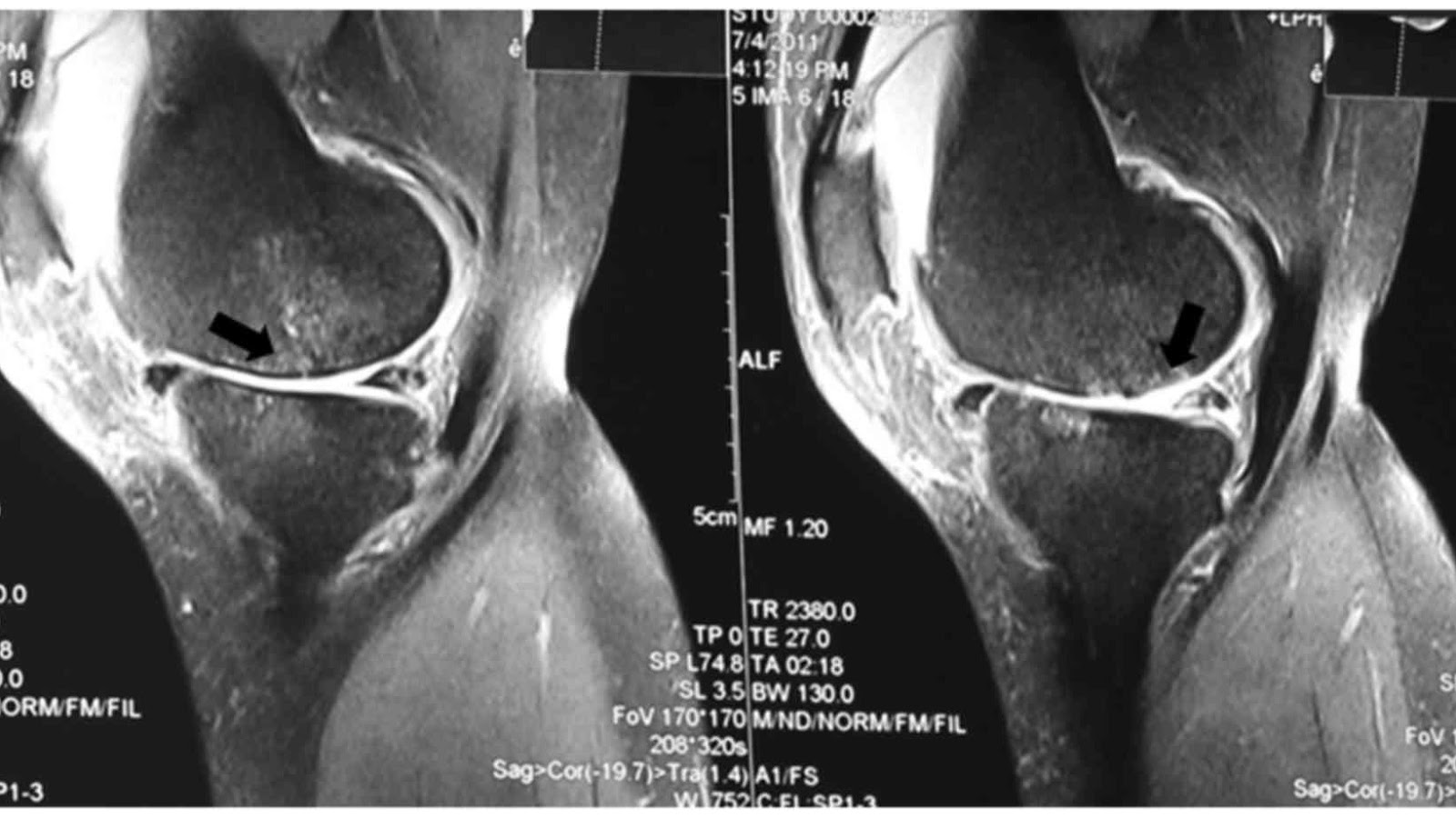 Chụp MRI khớp gối: Chỉ định và quy trình thực hiện 1