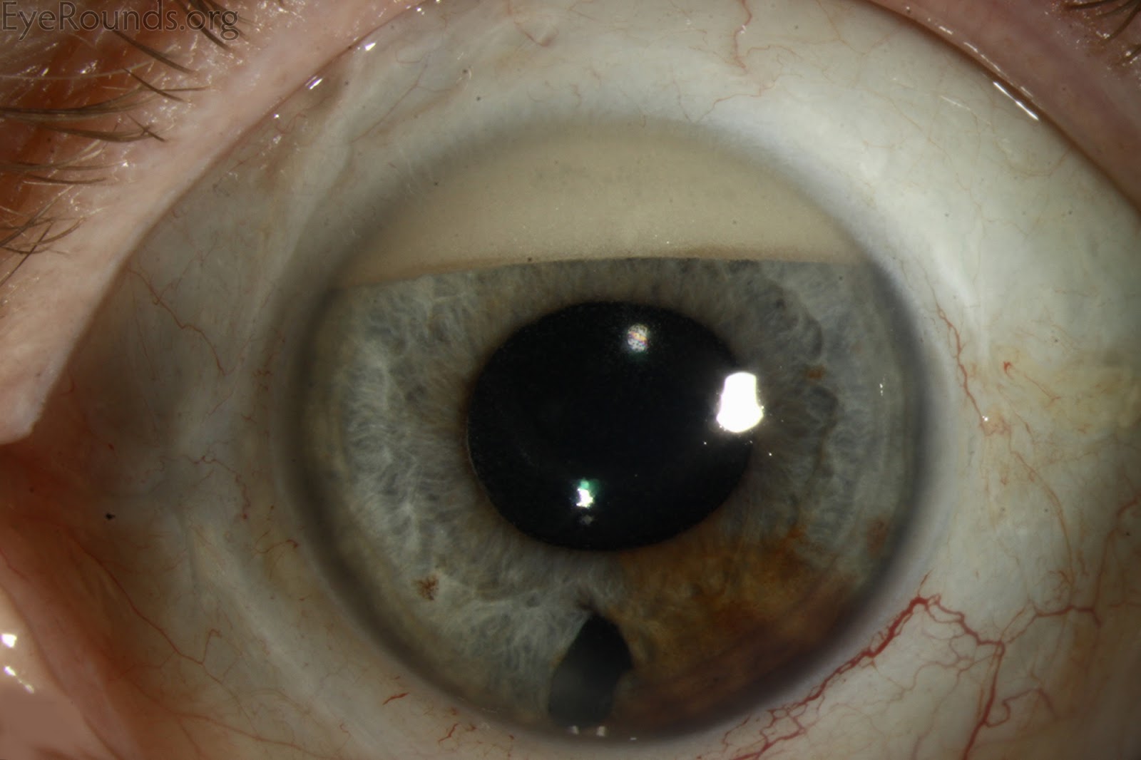 inflamasi mata (hipopion)