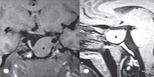 Şekil 1: Nüks akromegalik bir hastada preoperatif A) koronal ve B) sagittal kontrastlı sella MRG kesitleri (a: makroadenom).