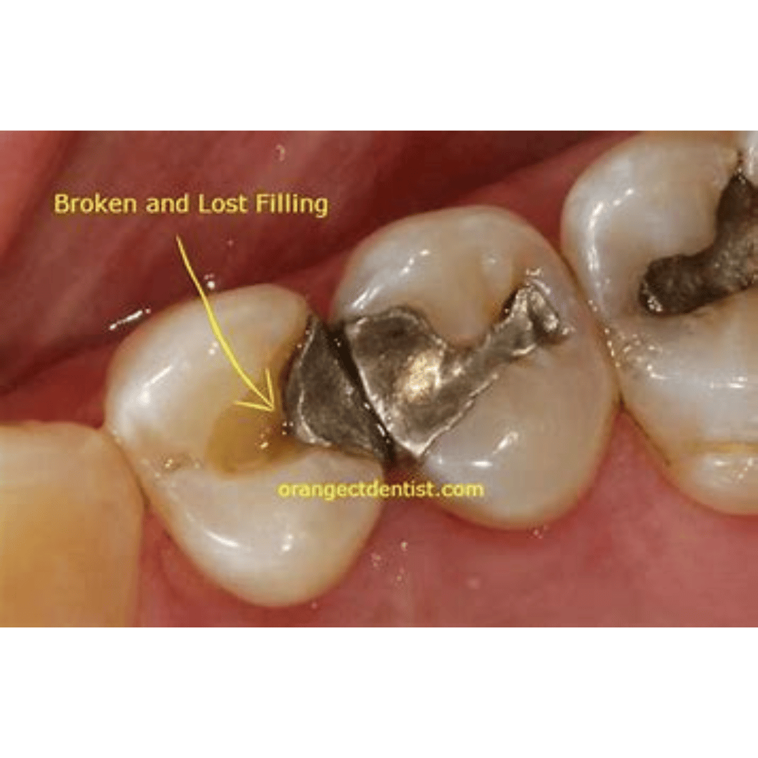 What to Do If Your Tooth Filling Fell Out?