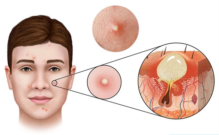 Làm sao để chăm sóc da khi mụn mủ đang chín?