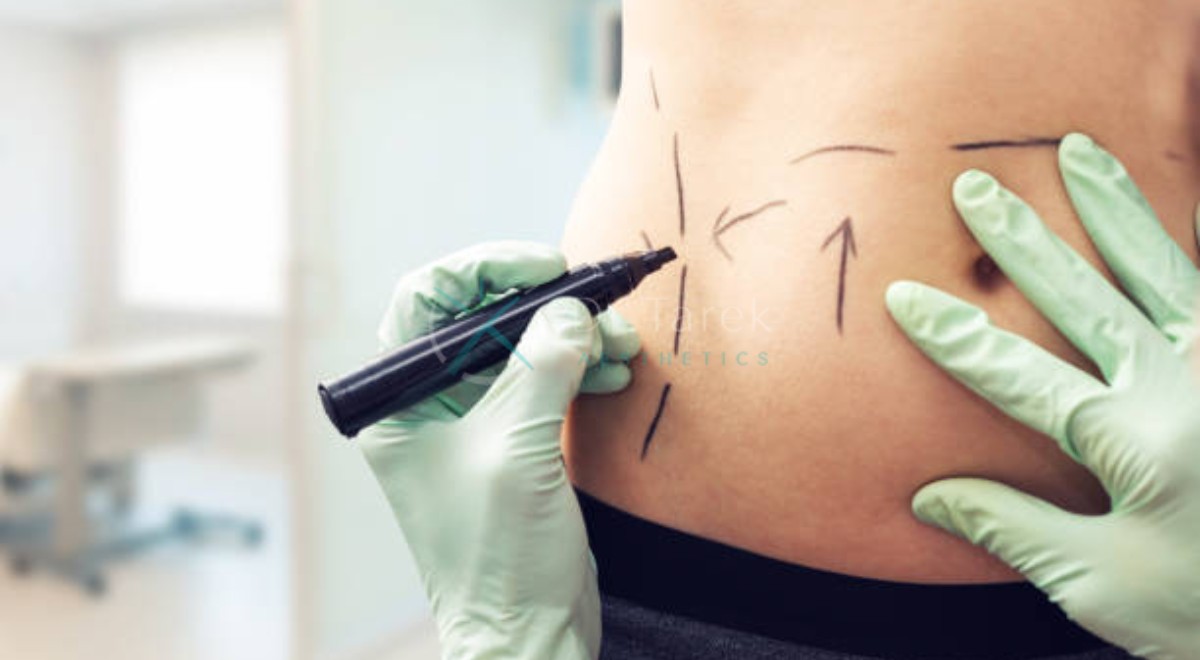 What Does Liposuction Do 4 Dr. Tarek Aesthetics | Best Plastic Surgeon In Dubai What Does Liposuction Do