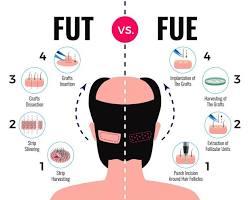 Image of FUE hair transplant procedure